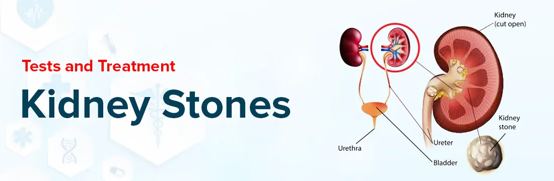 Kidney Stones – Tests and Treatment